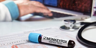 Monkeypox in 2026: What You Need to Know