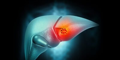 HCC Risk Factors: Early Intervention Strategies to Reduce Disease Burden