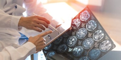 Which Stem Cell Types Are Most Effective in Stroke Treatment?